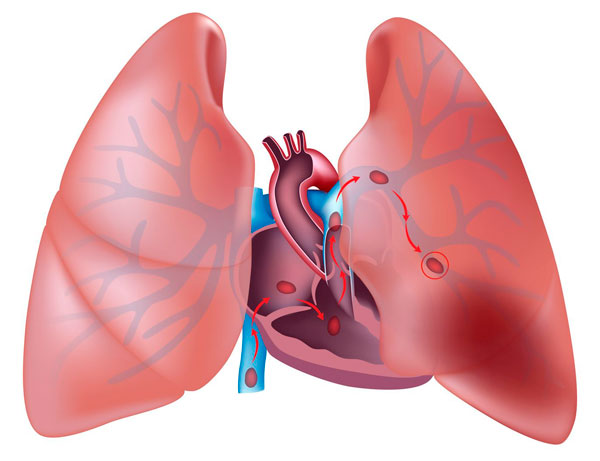 ill-pulmonary-embolism