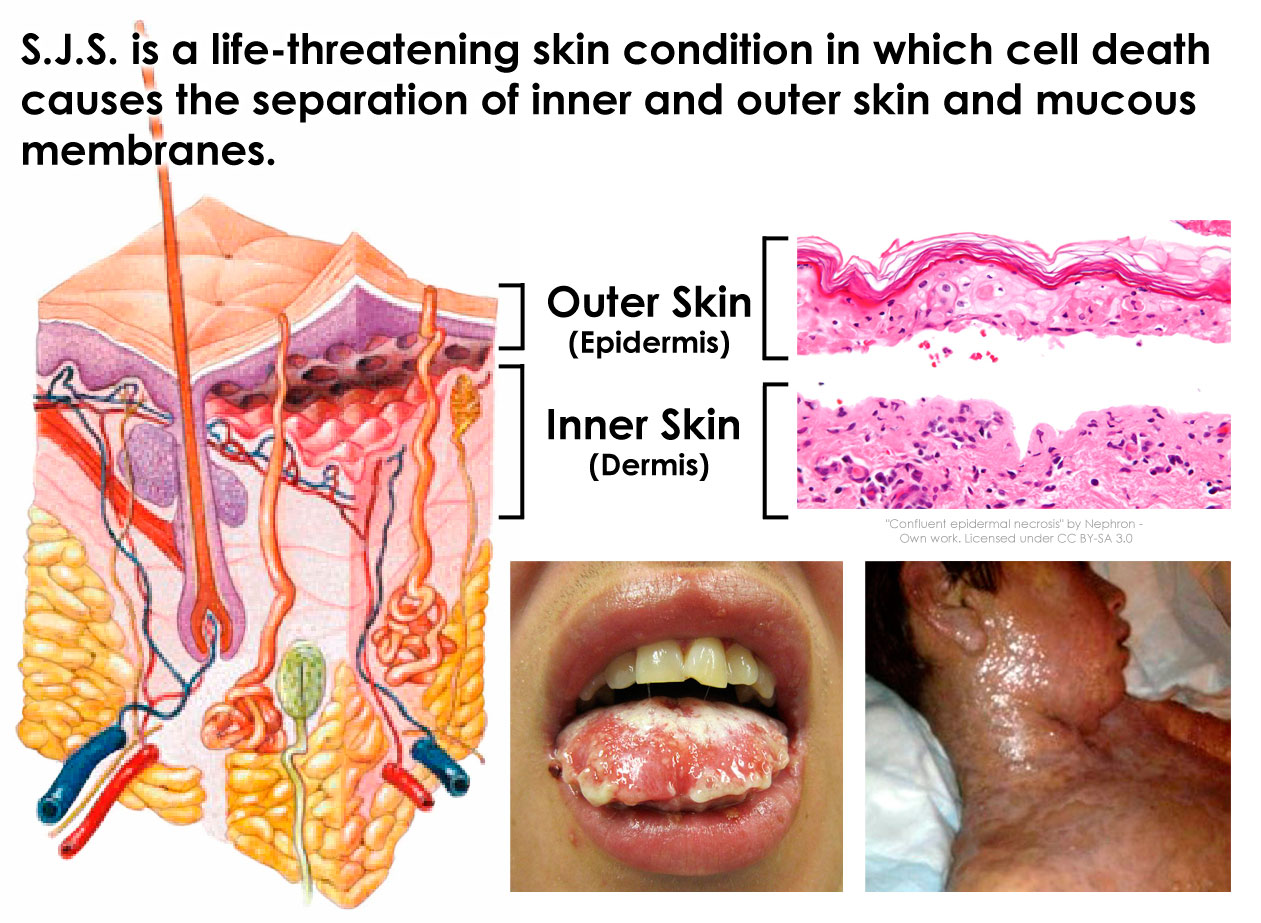 steven johnson syndrome