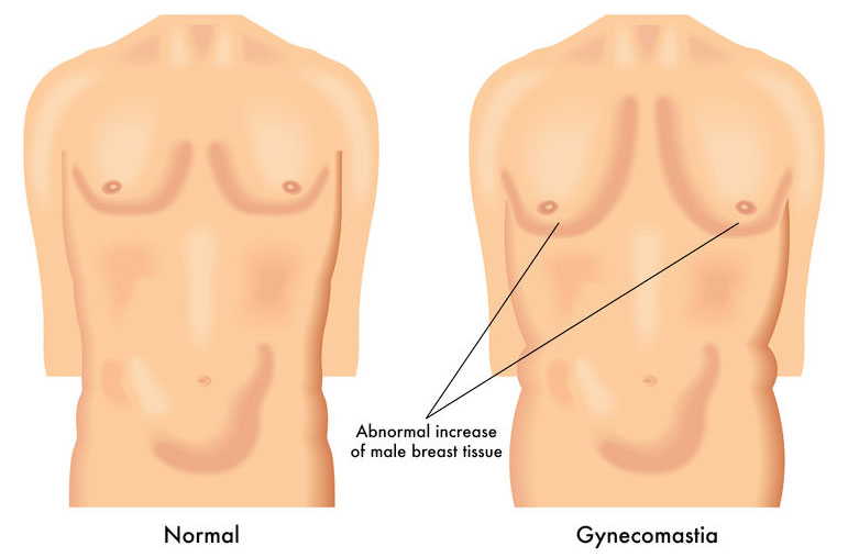 What Causes Man Boobs?