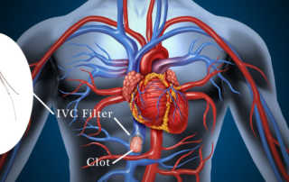 Causes of IVC Filter Breakage
