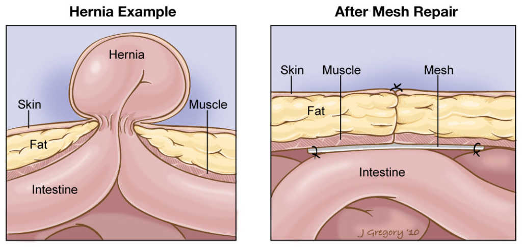 Hernia Mesh Repair illustration