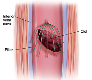 Blood Clot IVC Filter Causes