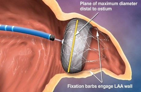 Watchman Stroke Devices Can Cause Serious Injuries - 215.546.2604 ...